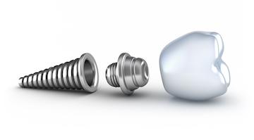 dental implant with crown | dentist arvada, co