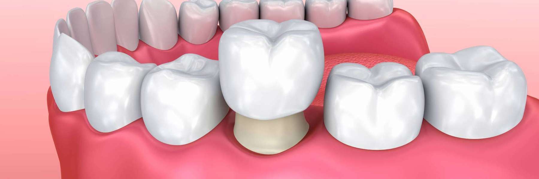 Model of strong, long-lasting CEREC crown on tooth restoration