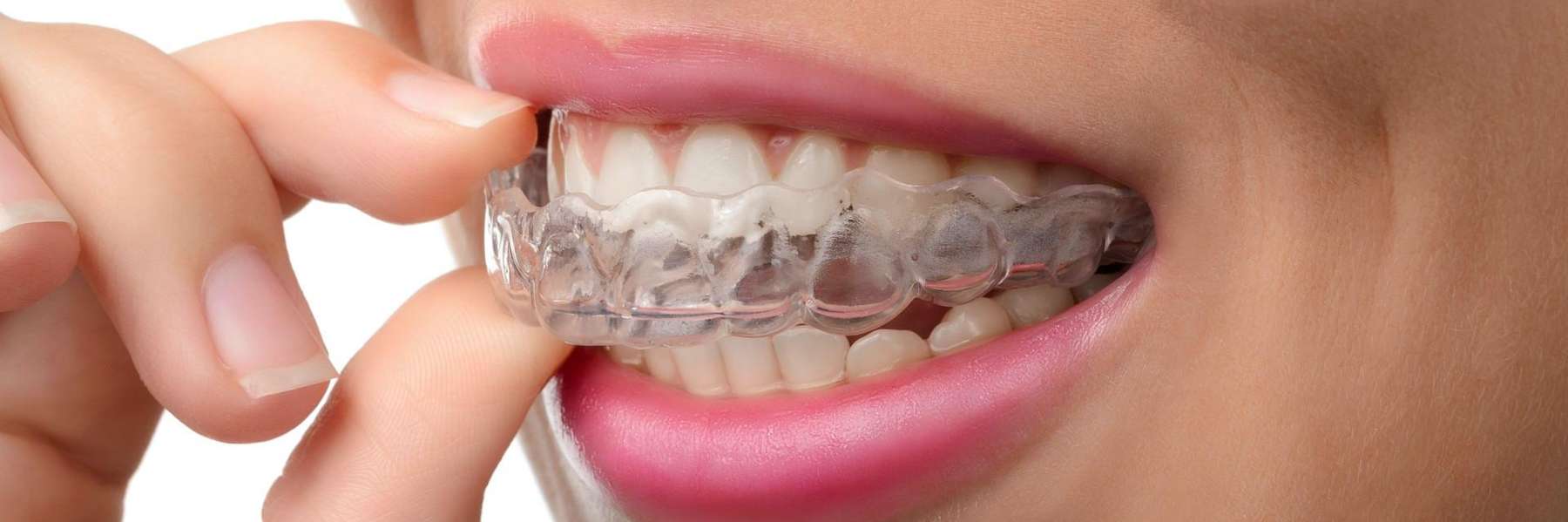 woman holding SureSmile® clear aligners