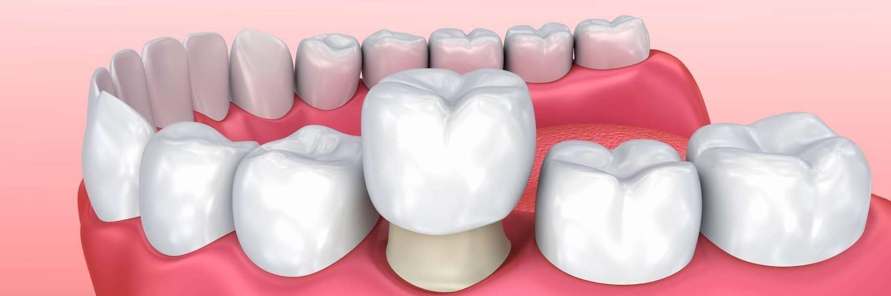 dental crown benefits in Arvada, CO