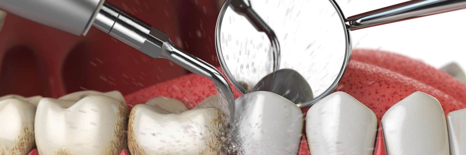 dental cleaning tools in arvada co